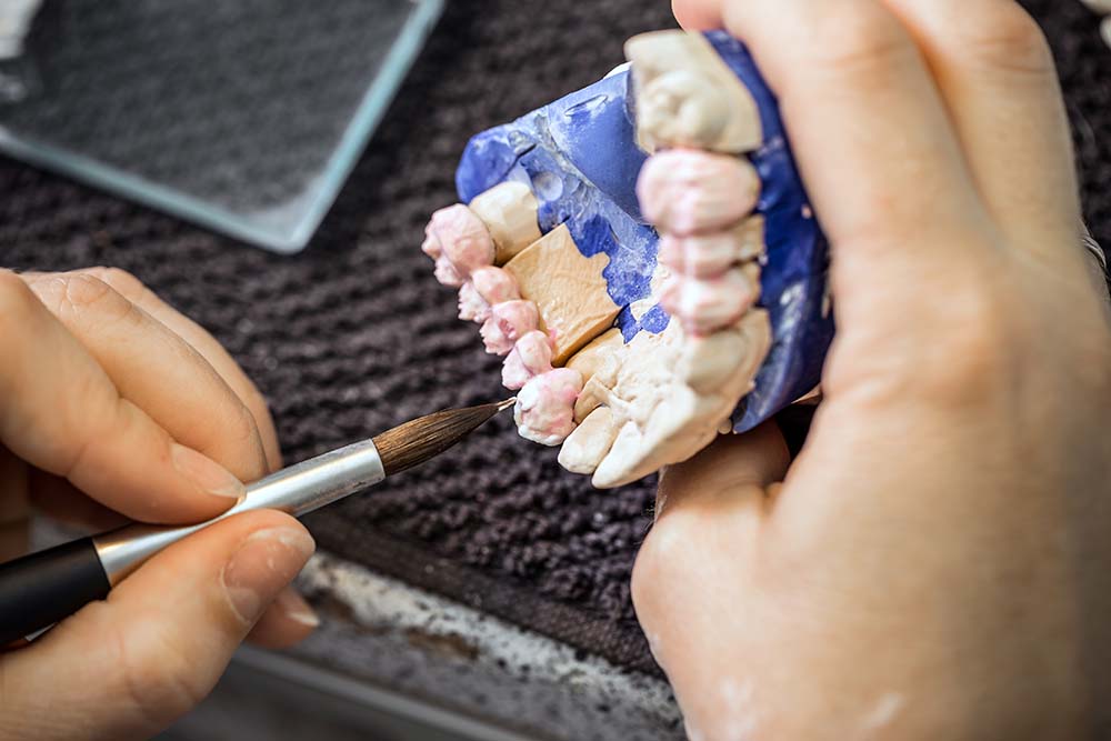 Dental Bridges